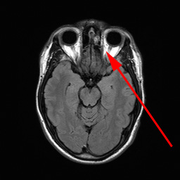oejne-normale oejne i niveau med oejennerven 1