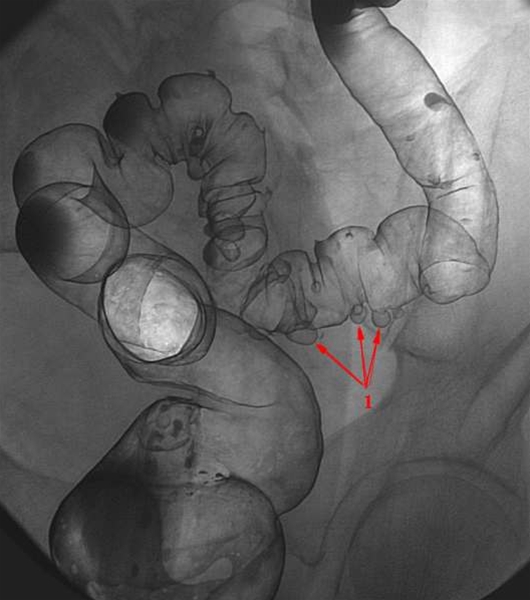 colon-divertikler-roentgen