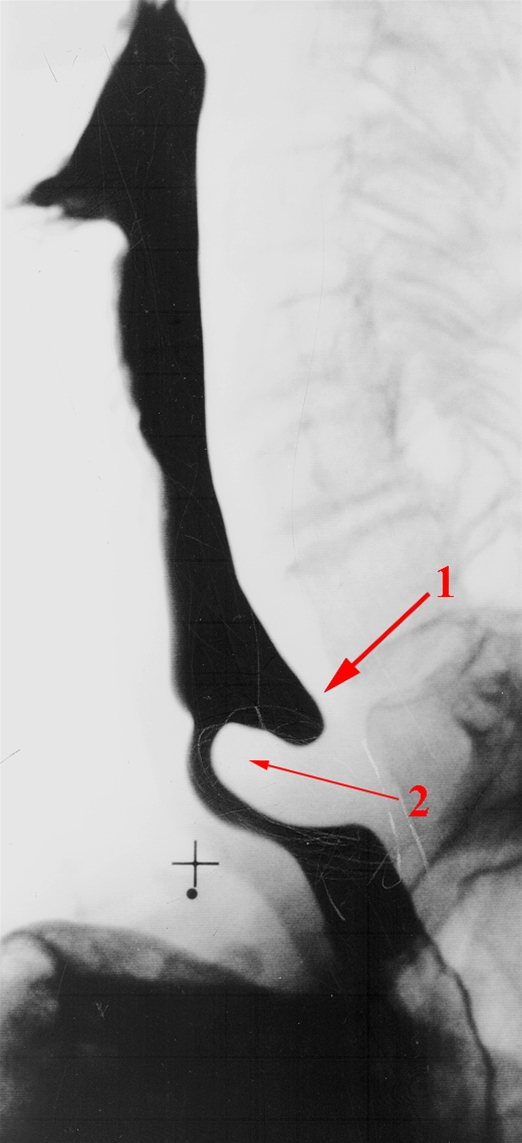 spiseroer-oesofagusdivertikel-roentgen