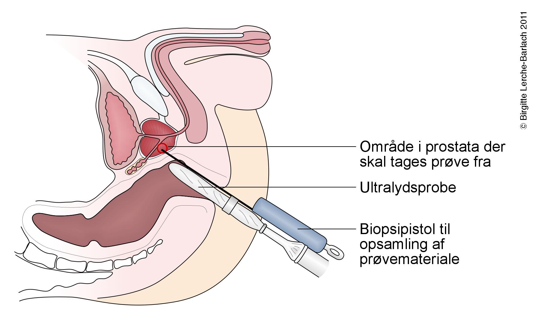 prostata-proevetagning