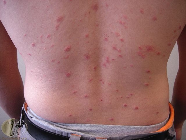 pityriasis rosea utslett