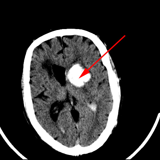 hjernen-cerebrum frisk bloedning-ct2