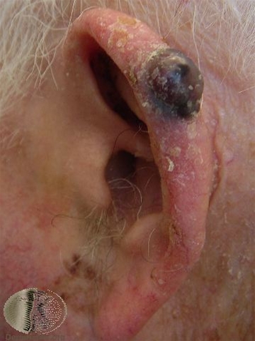 malignt melanom nodulaert