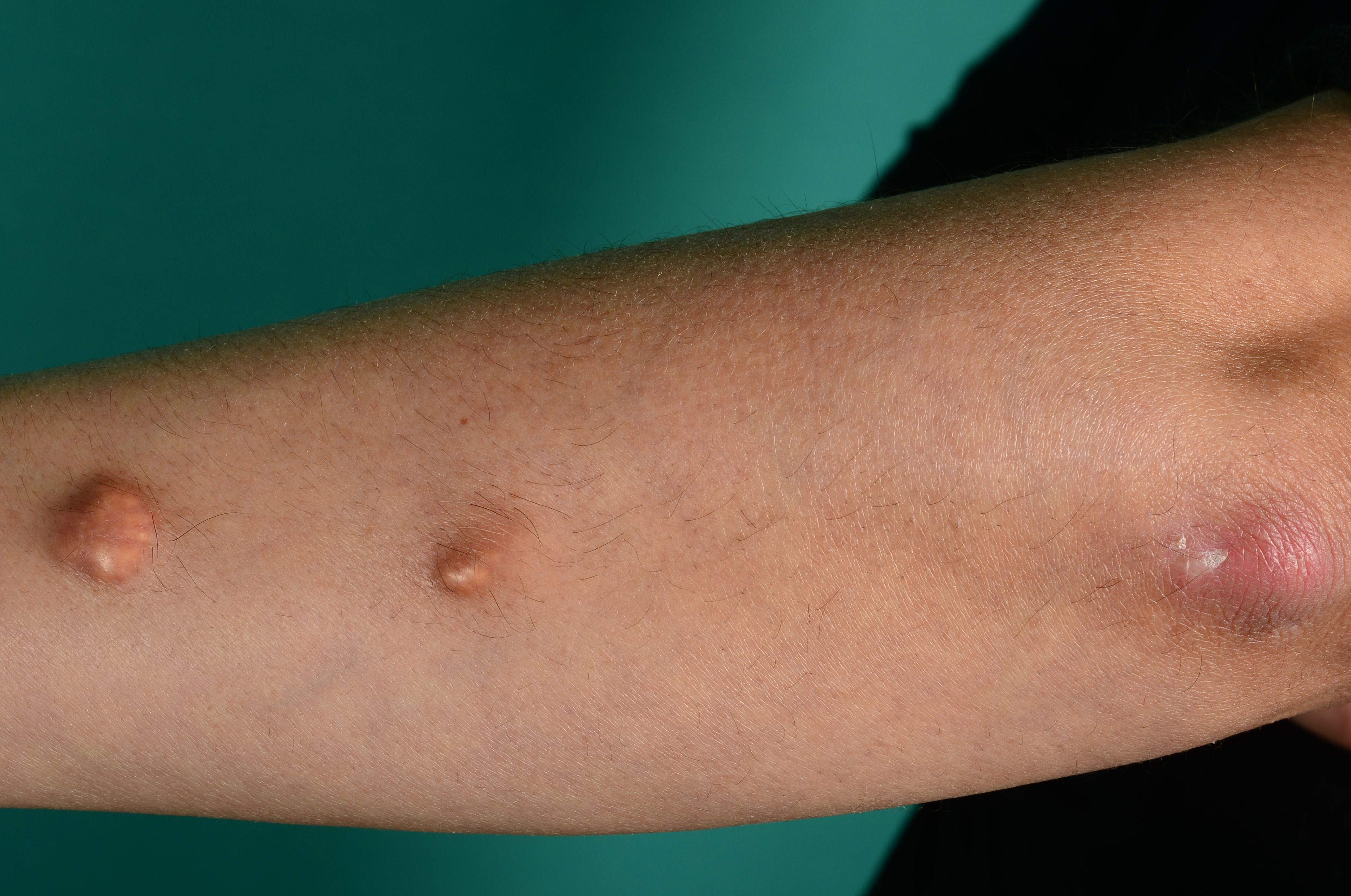 systemisk sklerodermi 50506