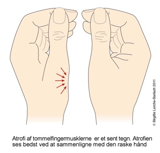 haender-karpaltunnelsyndrom