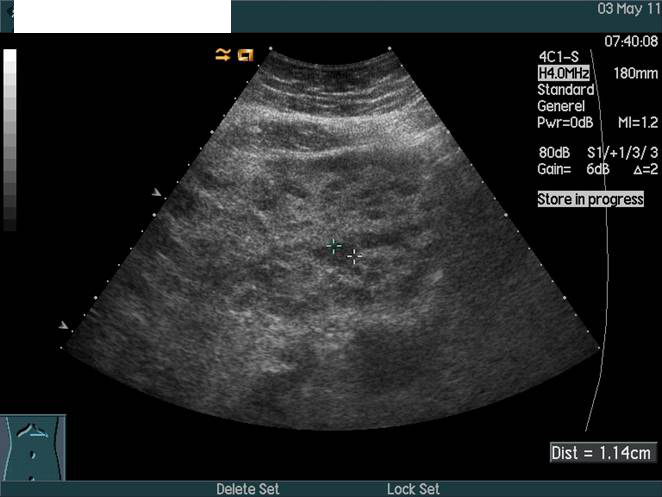 lever-lever stor UL uden kontrast-ultralyd