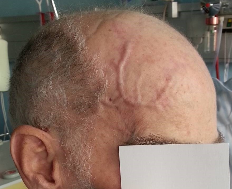 kaempecellearteritis