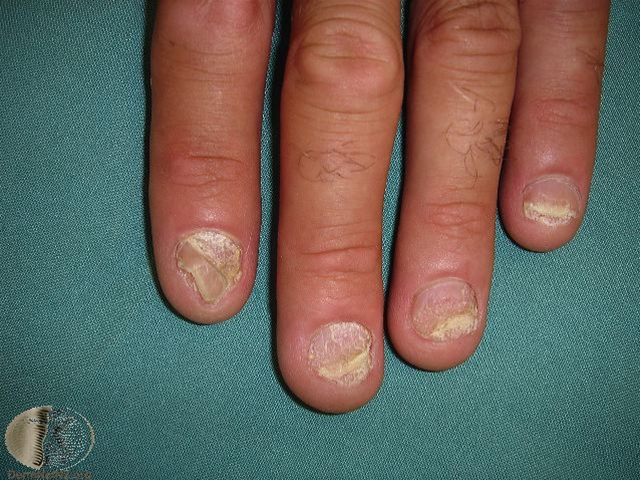 psoriasis negleforandringer