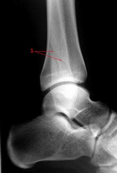 ankel-malleolfraktur sideoptagelse-roentgen