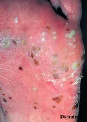 pustulosis palmo-plantaris 2