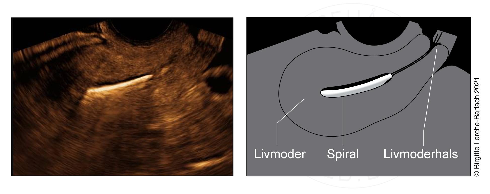 Livmoder med spiral2UL