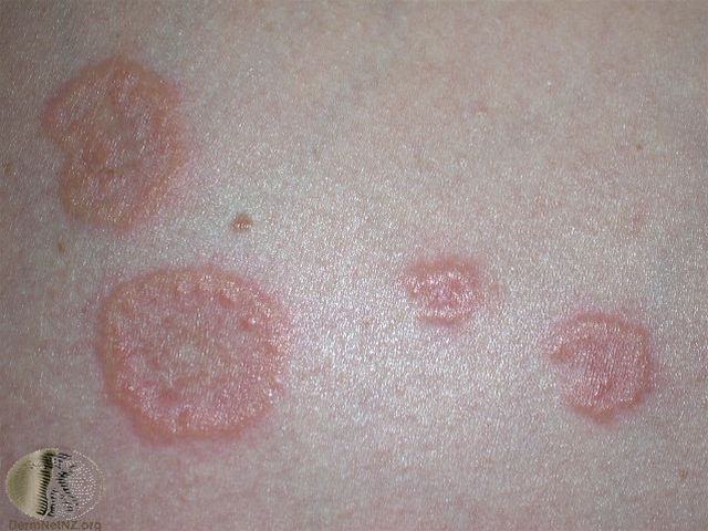 svangerskabs pemfigoid 2