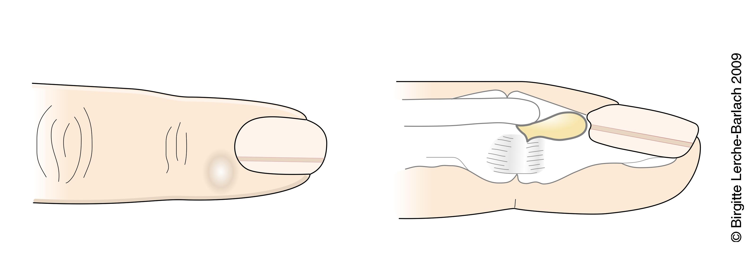 ganglion-finger