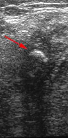 kaebe-sialoadenit konkrement-ultralyd