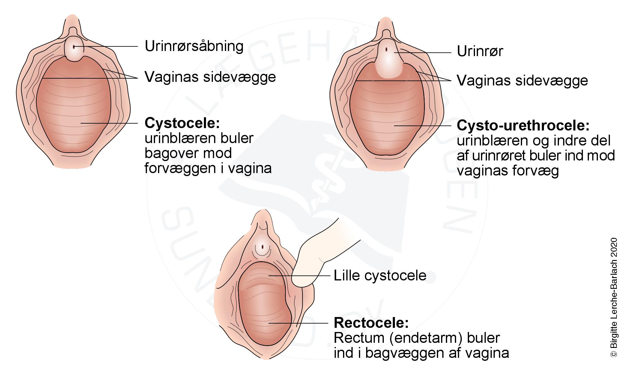 urinblaere-cysto urethro recto cele