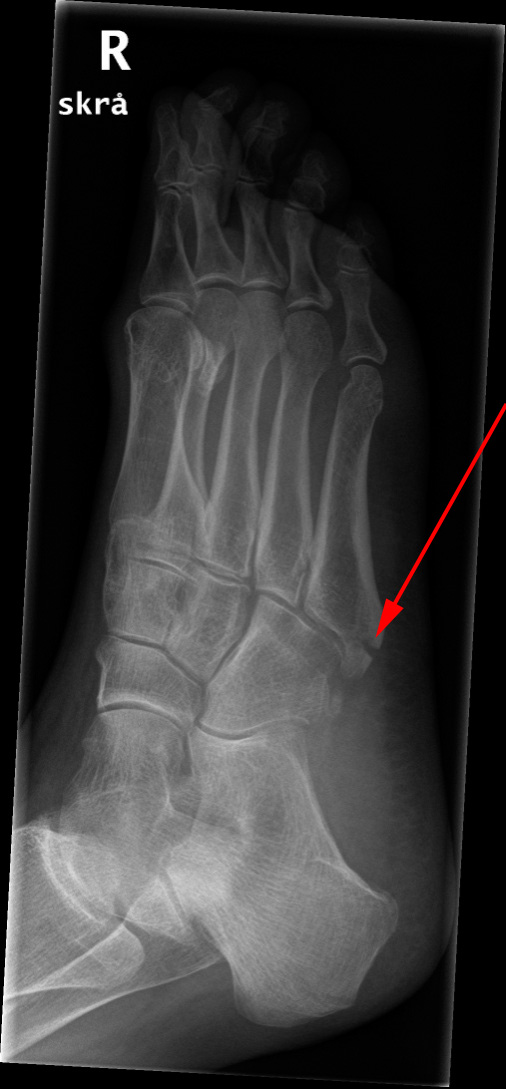 fod-fraktur-roentgen