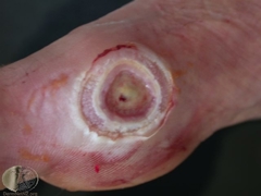 Foto viser diabetisk fodsår.
