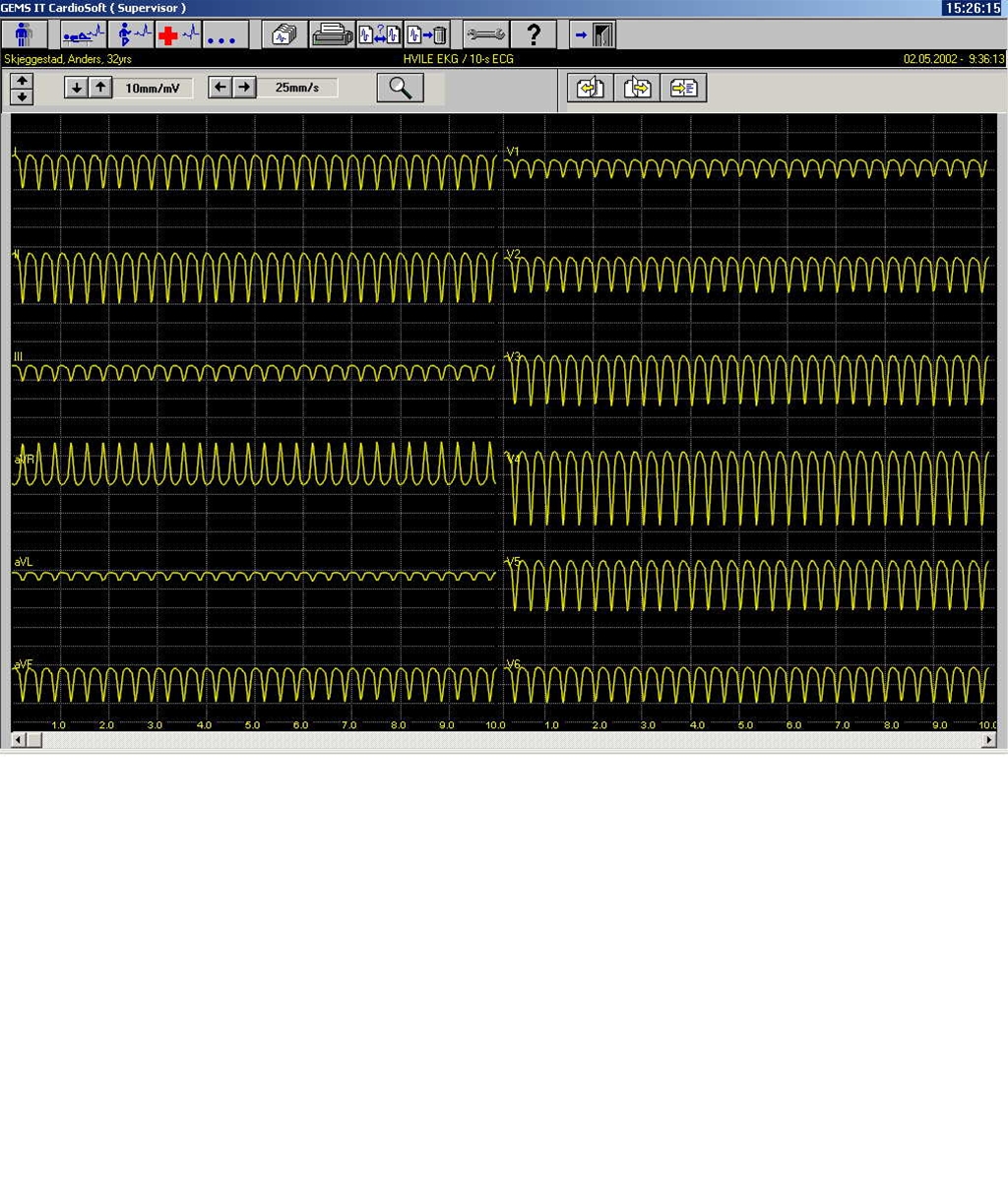 hjerte-ventrikulaer takykardi-ekg