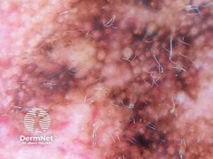 Pseudonetværk, strukturløse områder samt grå og koncentriske cirkler ved dermoskopi af lentigo maligna melanom