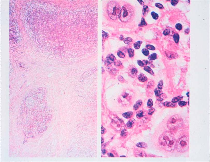 granulomatoes infiltration af lymfeknude med typiske typiske reed sternberg celler