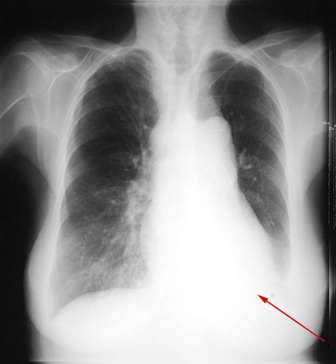 lunger-atelektase-rtg frontal-ny