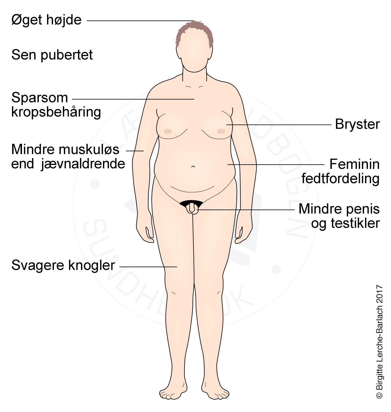 Klinefelters-syndrom