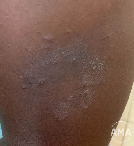 Foto af tinea corporis