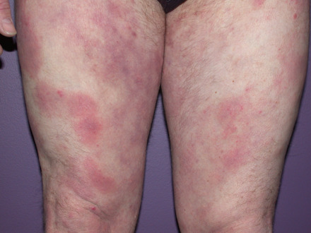 mycosis fungoides-pletter-2