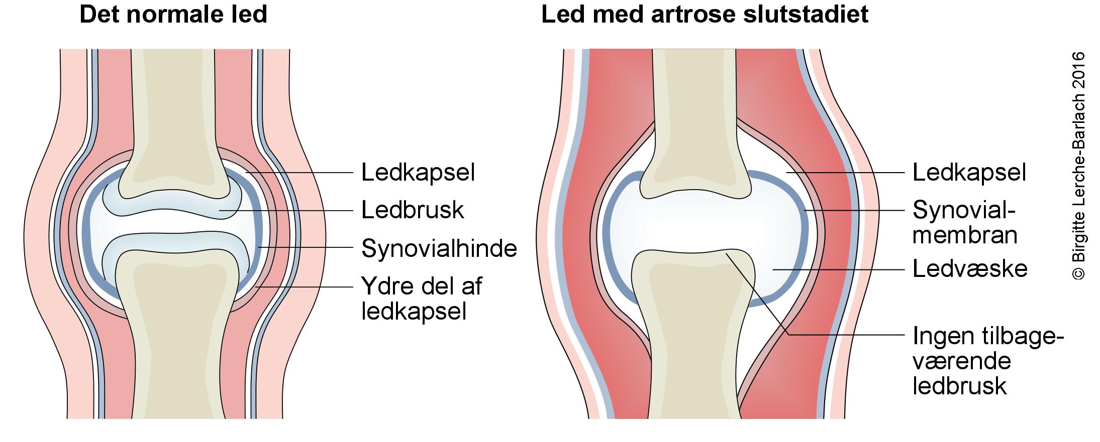 Artrose, - på sundhed.dk