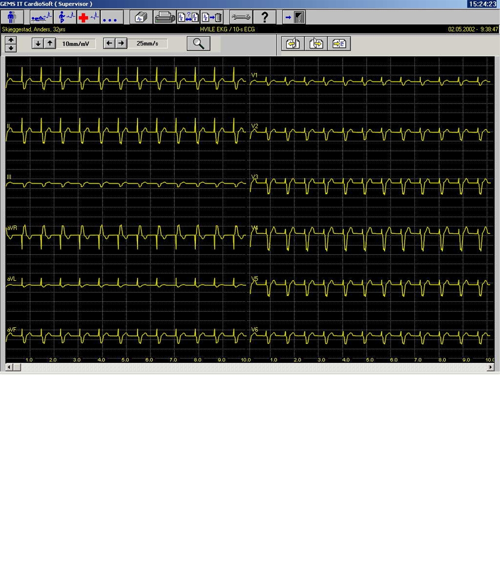 Pacemakerrytme - Patienthåndbogen på sundhed.dk