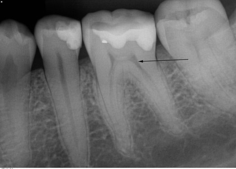 Pulpitis - Patienthåndbogen på sundhed.dk