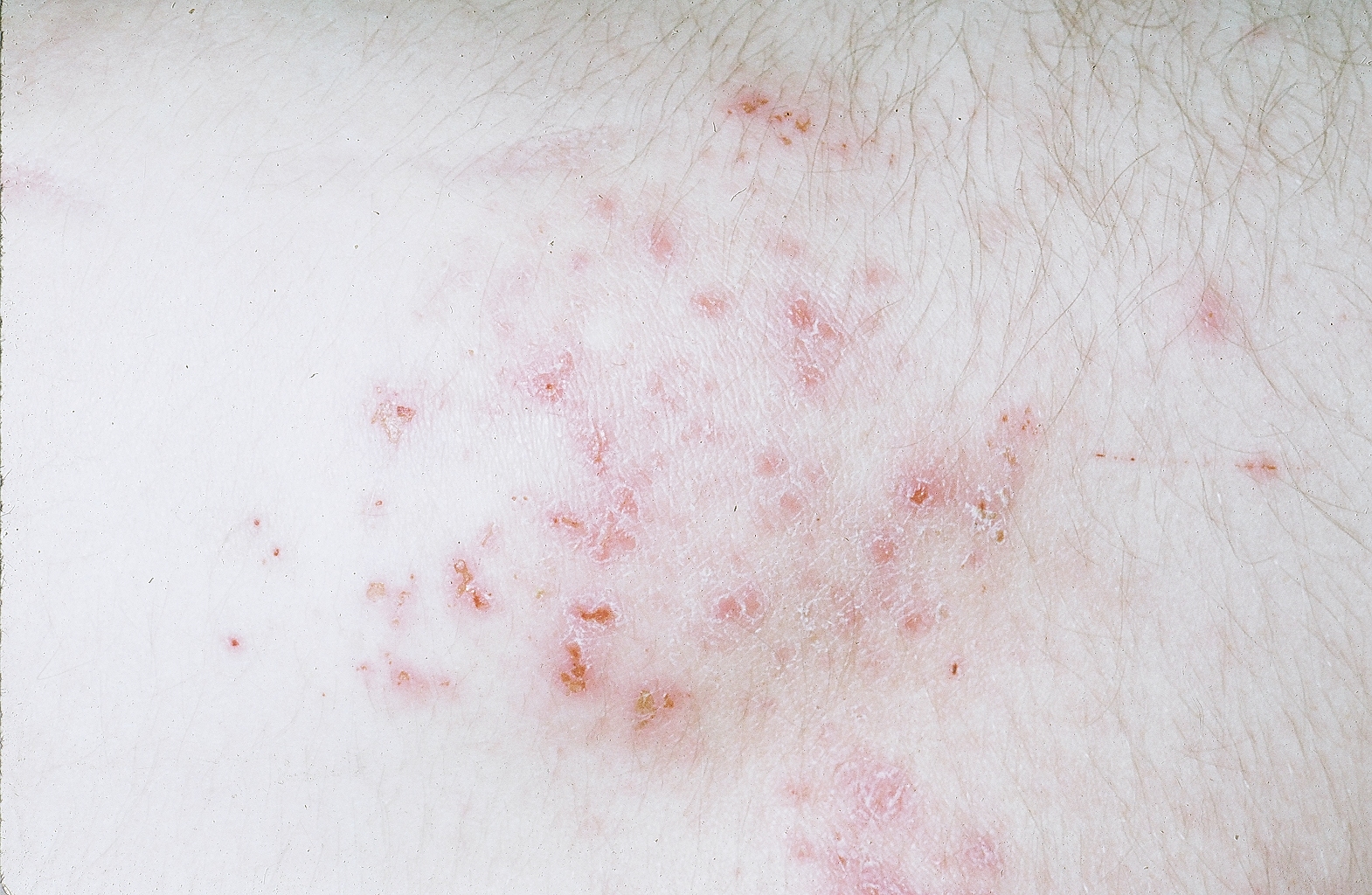 dermatitis-herpetiformis-l-geh-ndbogen-p-sundhed-dk