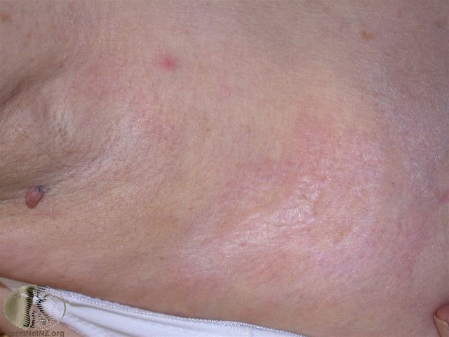 Extragenital Lichen Sclerosus Et Atrophicus