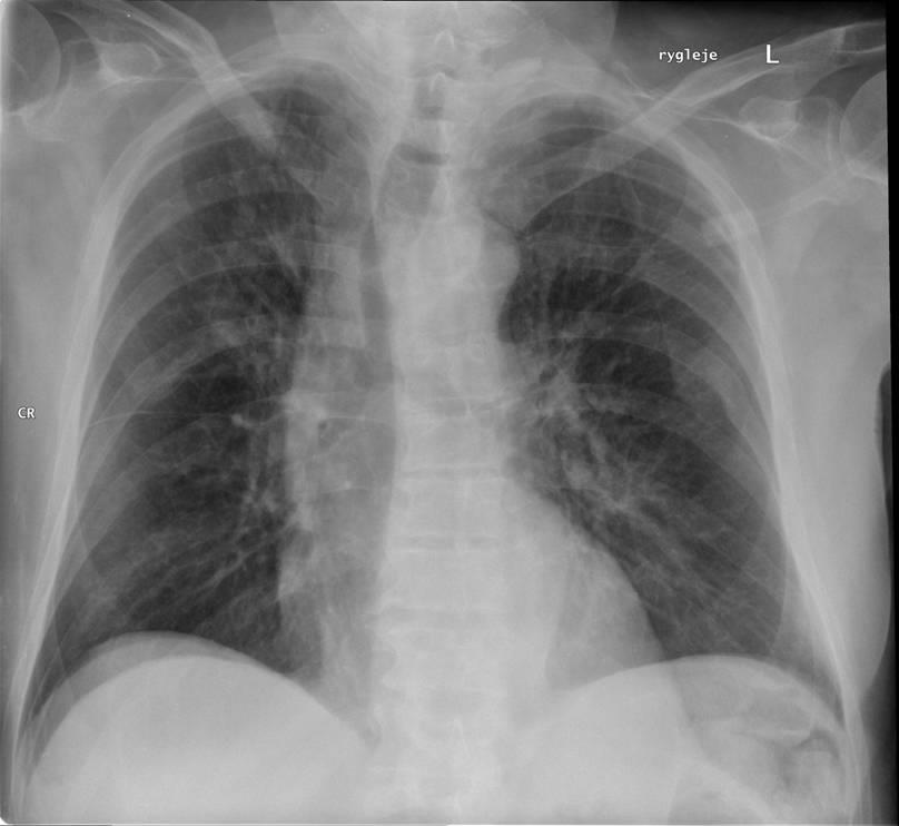 Lunger, røntgen og CT - Lægehåndbogen