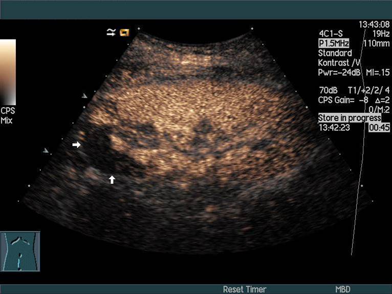 Nyre, Infarkt, Ultralyd Lægehåndbogen på sundhed.dk