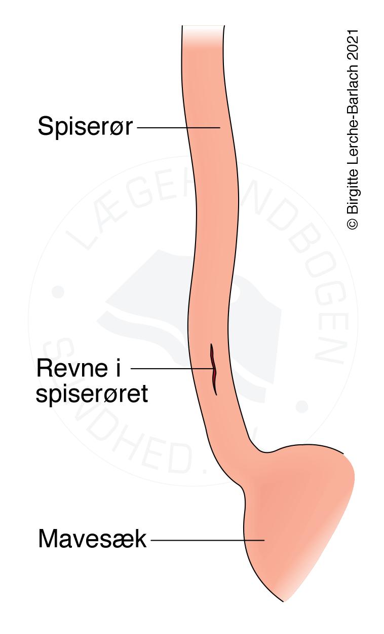 Spiser Roe Hul i spiserøret - Patienthåndbogen på sundhed.dk
