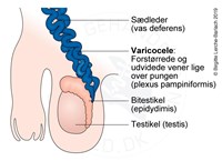 Årebrok (varicocele) - Patienthåndbogen sundhed.dk