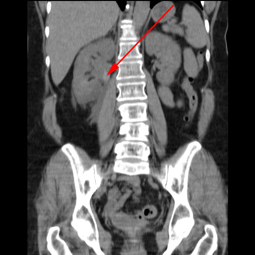 Nyre Malign Tumor Ct 1 Laegehandbogen Pa Sundhed Dk