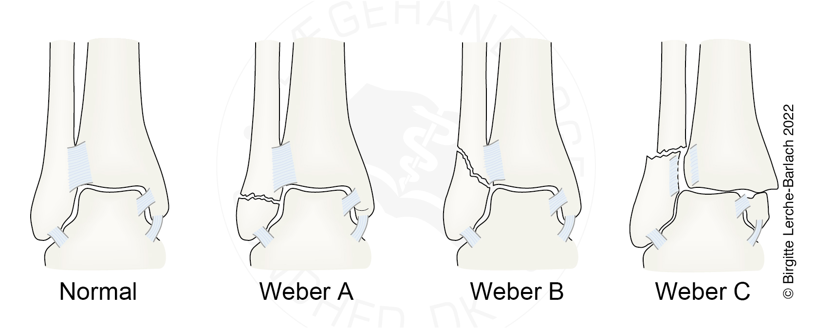 Ankel, frakturer Lægehåndbogen på sundhed.dk